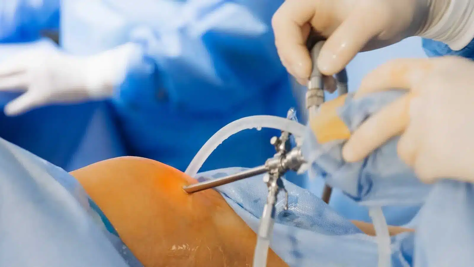 Laparoscopic Fundoplication
